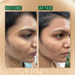 *Spot Corrector & Acne Marks Correcting Advanced Booster Serum